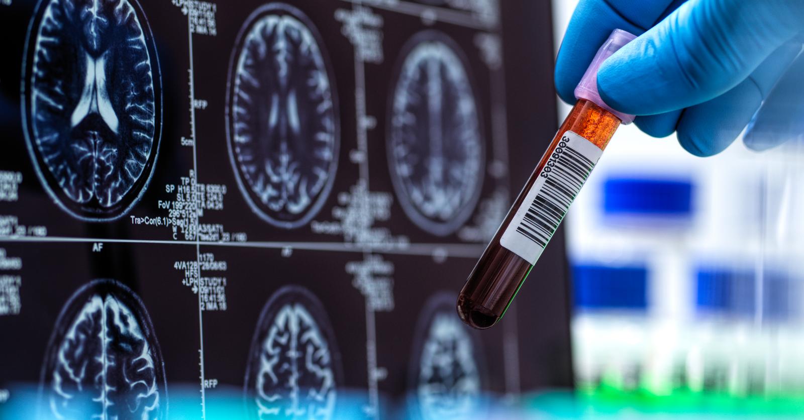 Alzheimer: bientôt un test sanguin disponible pour diagnostiquer la ...