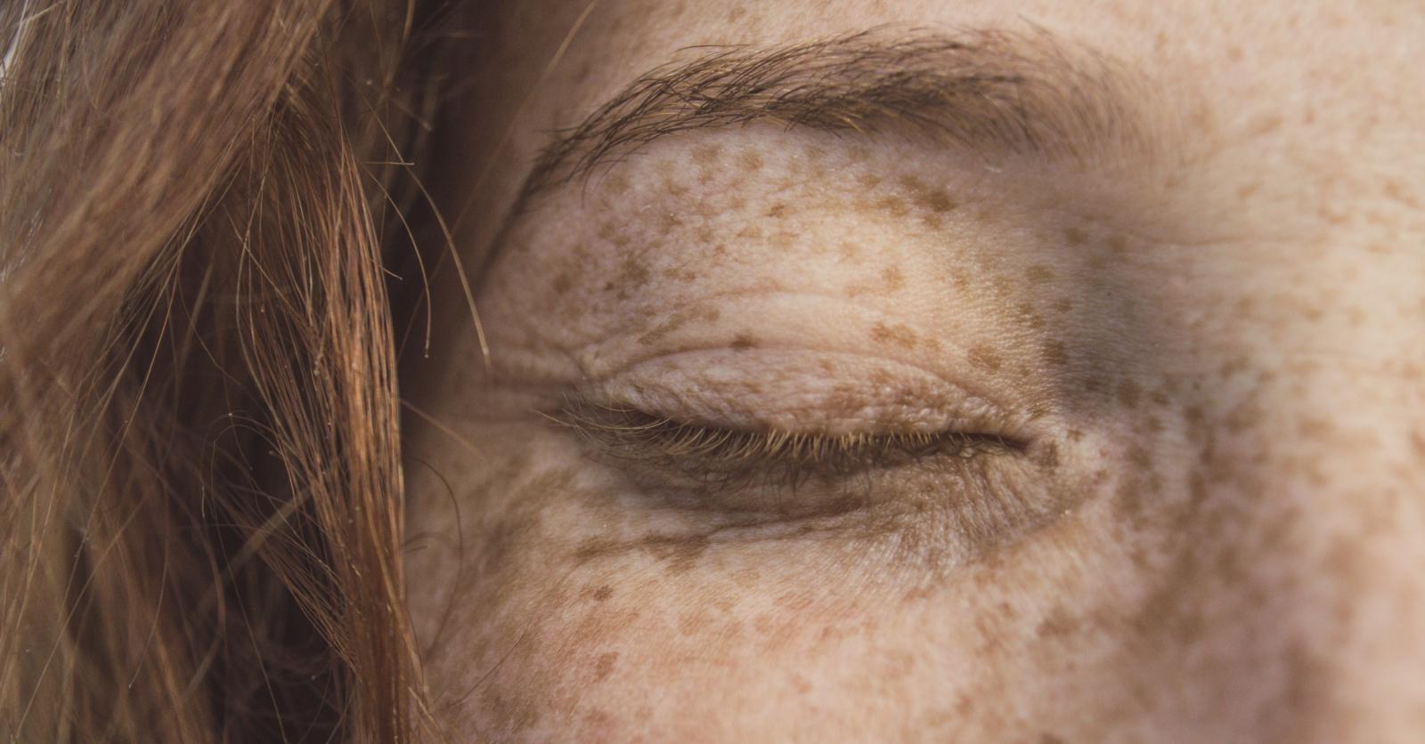 How to Identify and Treat Different Types of Spots on Your Skin | Dermatologist Insights