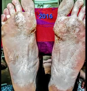 This is what Karel Sapp's feet looked like when he walked the Pacific Crest Trail in 2016.