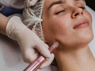 Notre journaliste beauté a testé le microneedling - Canva