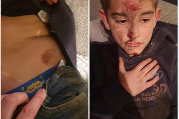 De 9-jarige Leon liep verschillende verwondingen op, vooral in het gezicht.©Olaf Verhaeghe gf