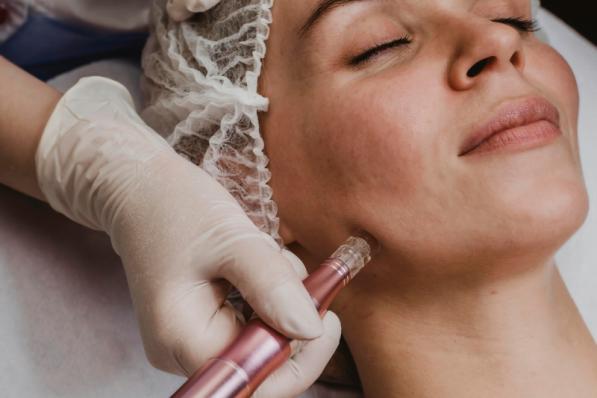 Notre journaliste beauté a testé le microneedling - Canva
