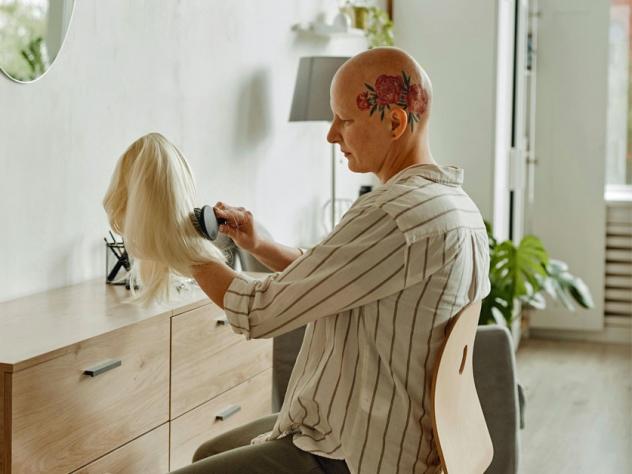 alopecia