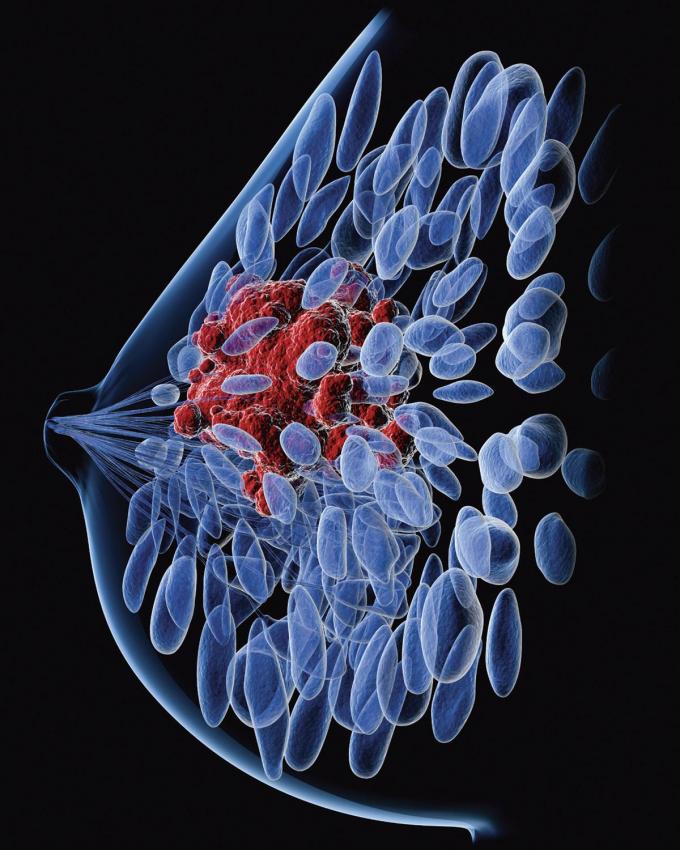 In borstweefsel zitten verrassend veel afweercellen die nuttig kunnen zijn in de strijd tegen kanker.