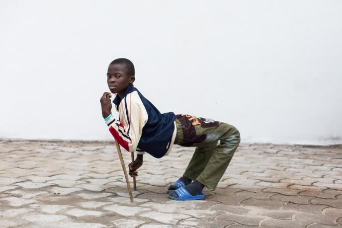 Ulrich voor zijn operatie. (foto Mercy Ships)