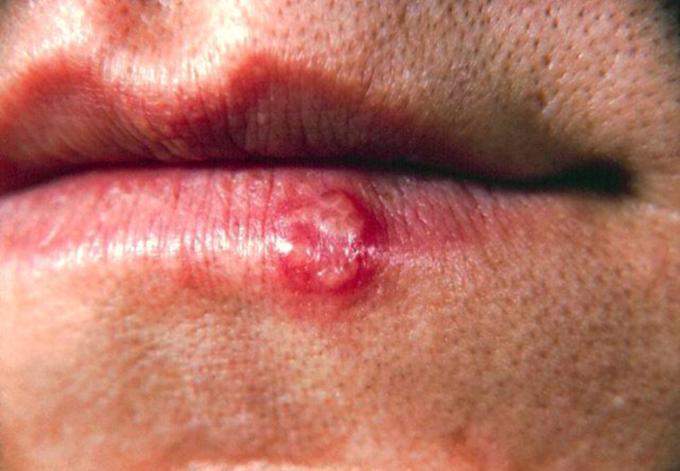 Boutons de fièvre: 5 remèdes pour les faire disparaître plus vite