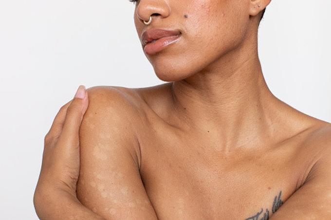 Les femmes cicatrisent plus vite: en quoi cette découverte pourrait aider à prévenir le cancer de la peau