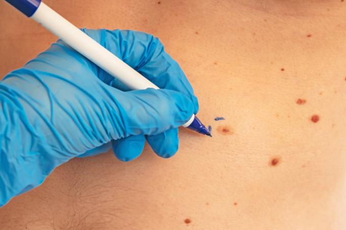 Cancers de la peau: voici quand il faut s’inquiéter pour ses grains de beauté