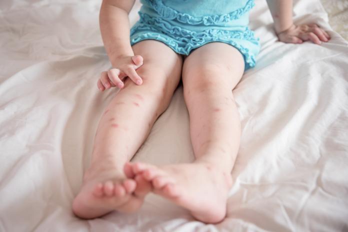 Mosquito bites sore on child legs