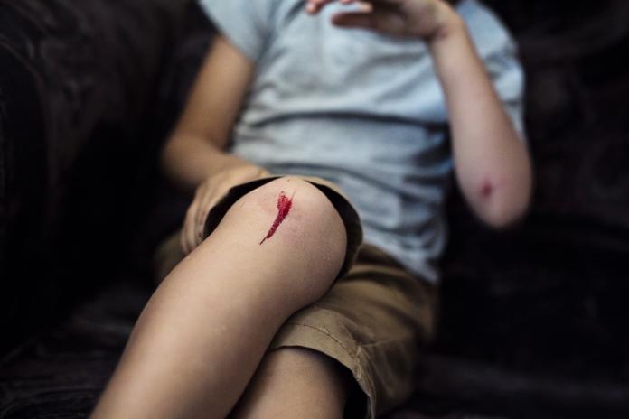 Boy with scraped knee