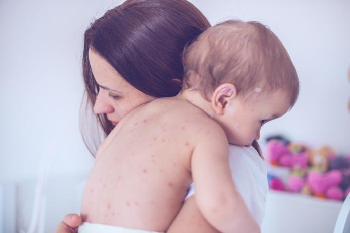 Mother taking care of baby with chicken pox mazelen