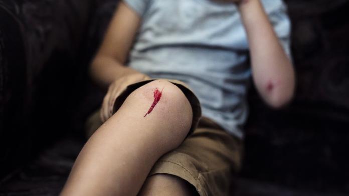 Boy with scraped knee