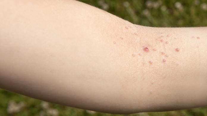 Molluscum contagiosum (MC) parelwratjes