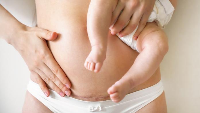 Closeup of woman belly with a scar from a cesarean section. Woman with baby on hand bevallen keizersnede gentle sectio