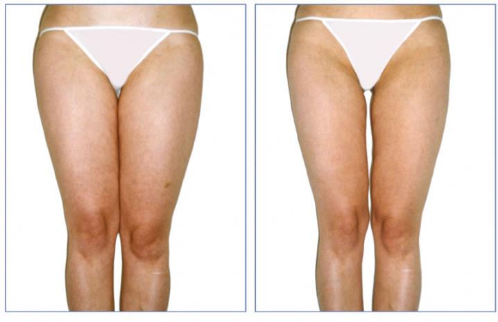 LPG endermologie avant apres