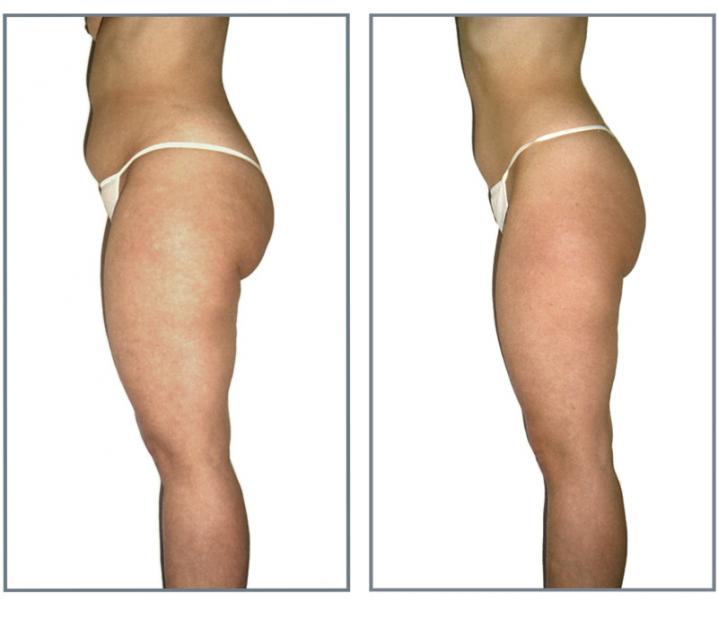 LPG endermologie avant apres2