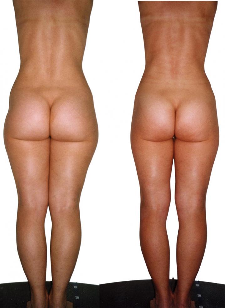 LPG endermologie avant apres3