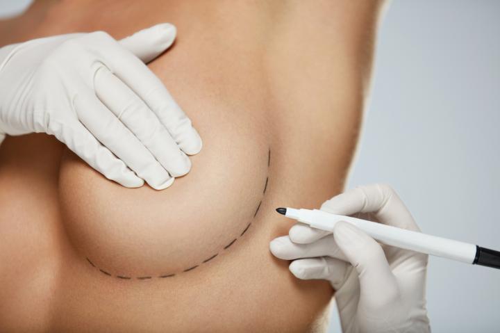 implants mammaires