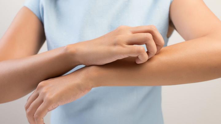 Daarom lijken muggenbeten dit jaar erger Daarom lijken muggenbeten dit jaar erger