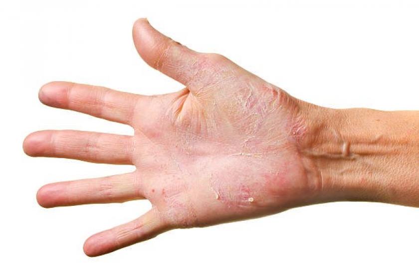 periode ontbijt spek Droge handen door het vele wassen? Met deze dermatologische tips vermijd je  ze - Libelle