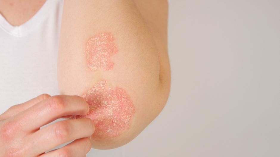 psoriasis