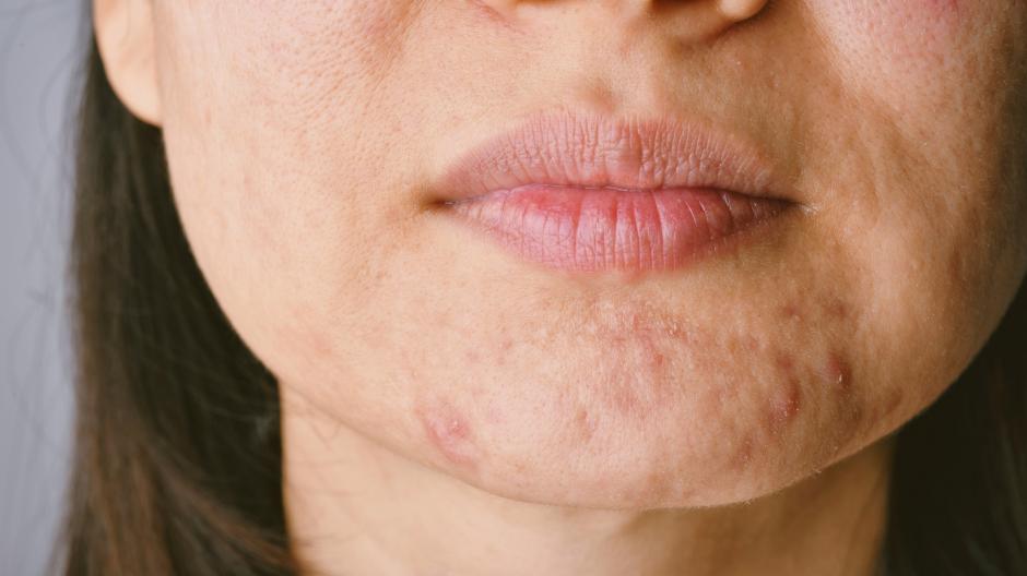 littekens acne