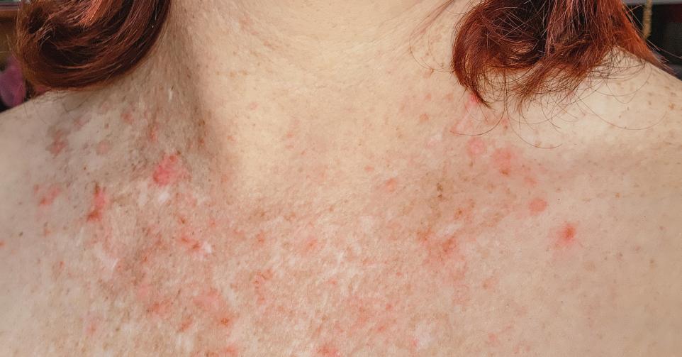 Psoriasis